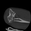 SPORK, NICO - 22.03.1976 - 02.08.2022 - CT obere Extremität - 17:59:38